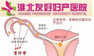 宮外孕，你忽視了嗎