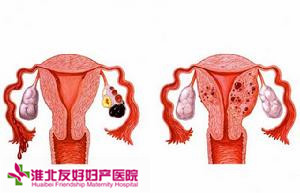 什么是子宮內(nèi)膜異位癥