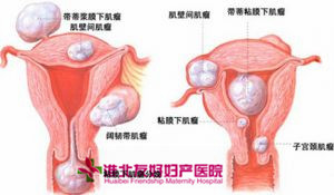 淮北治療子宮肌瘤價格